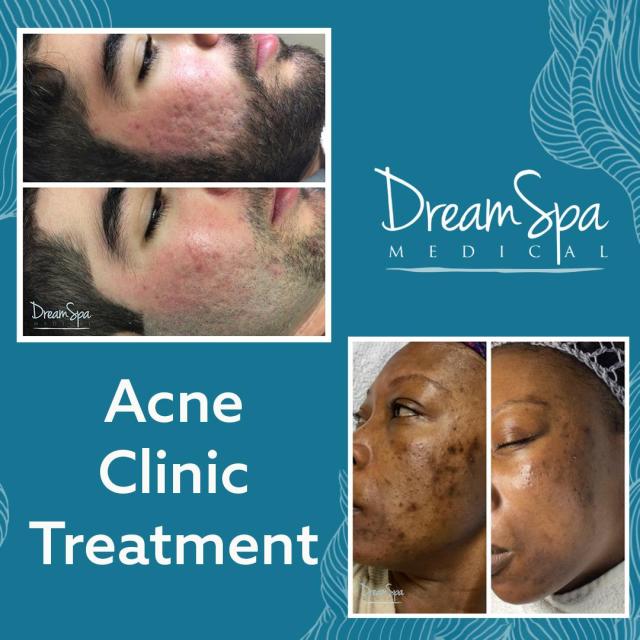 $75 Off Your First Acne Clinic Treatment